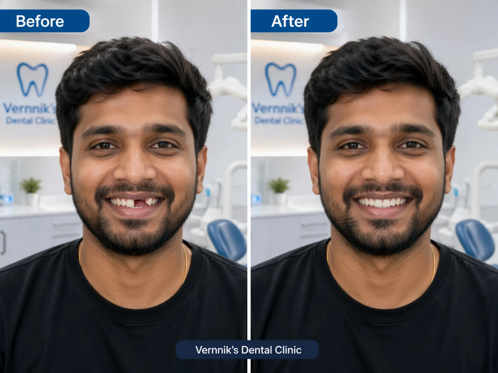 Before and after Single-Tooth Implant