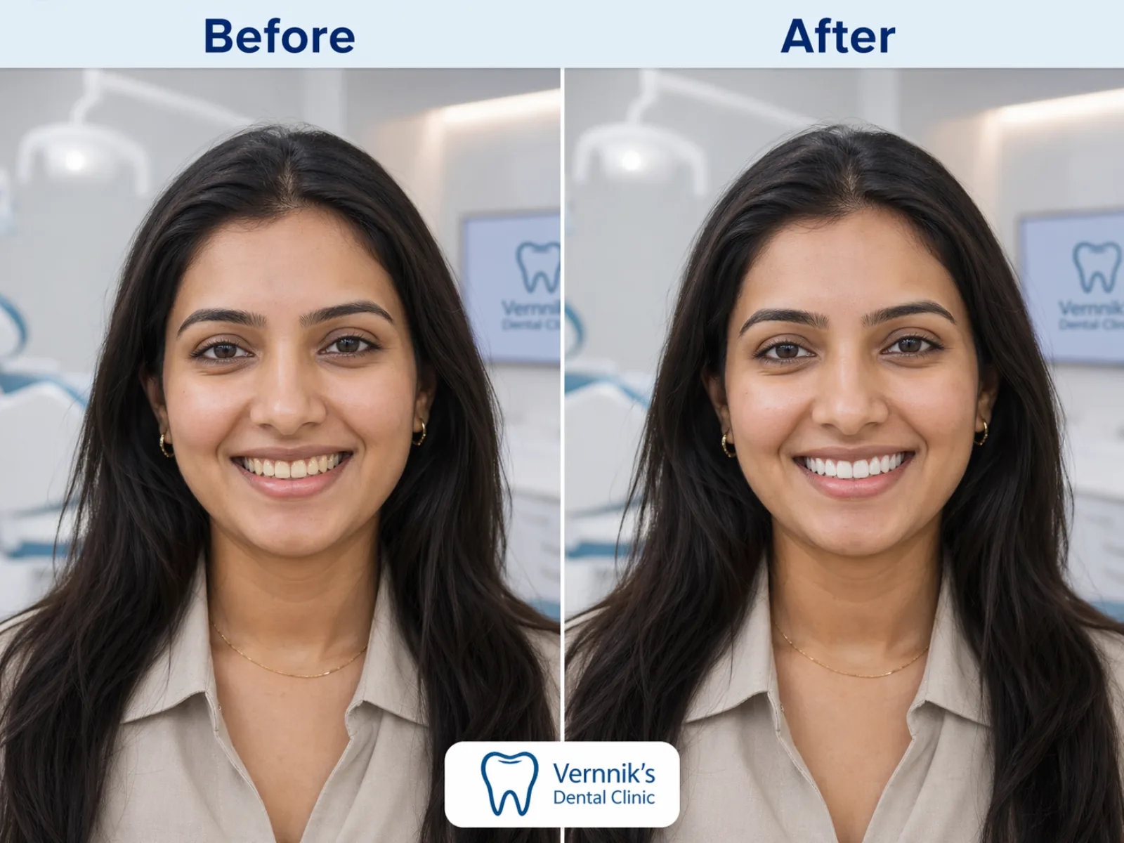 Before and after Smile Makeover with Veneers
