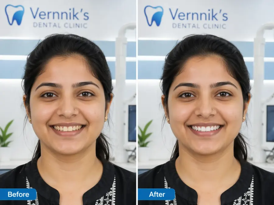 Before and after Teeth Whitening Result