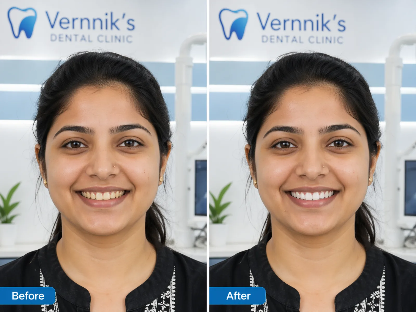 Before and after Teeth Whitening Result